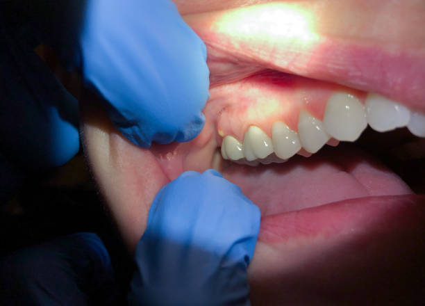 Best Lost Filling or Crown Replacement in Rosenhayn, NJ